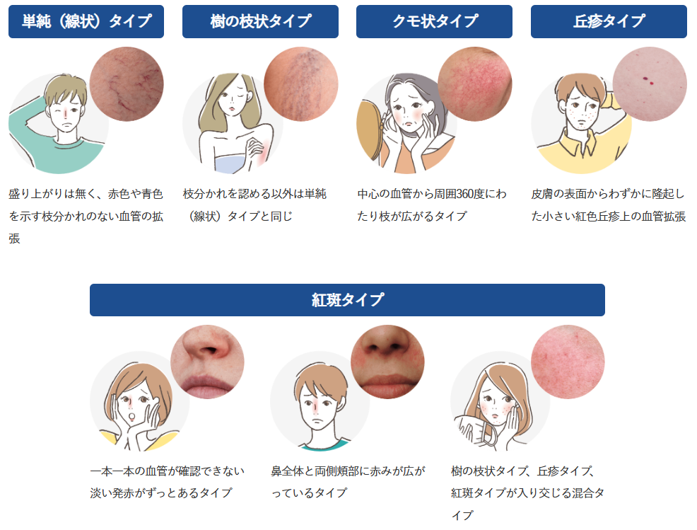 Tipos de telangiectasia