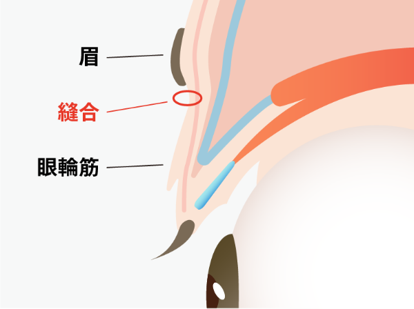 처치