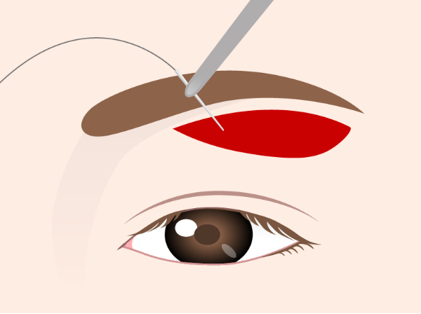 봉합